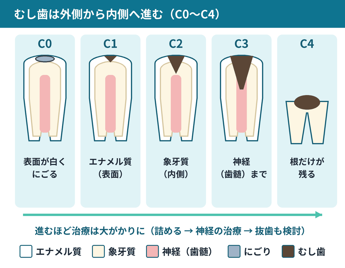 歯の構造の簡単な図と、むし歯の進み方C0からC4までの段階を示す図