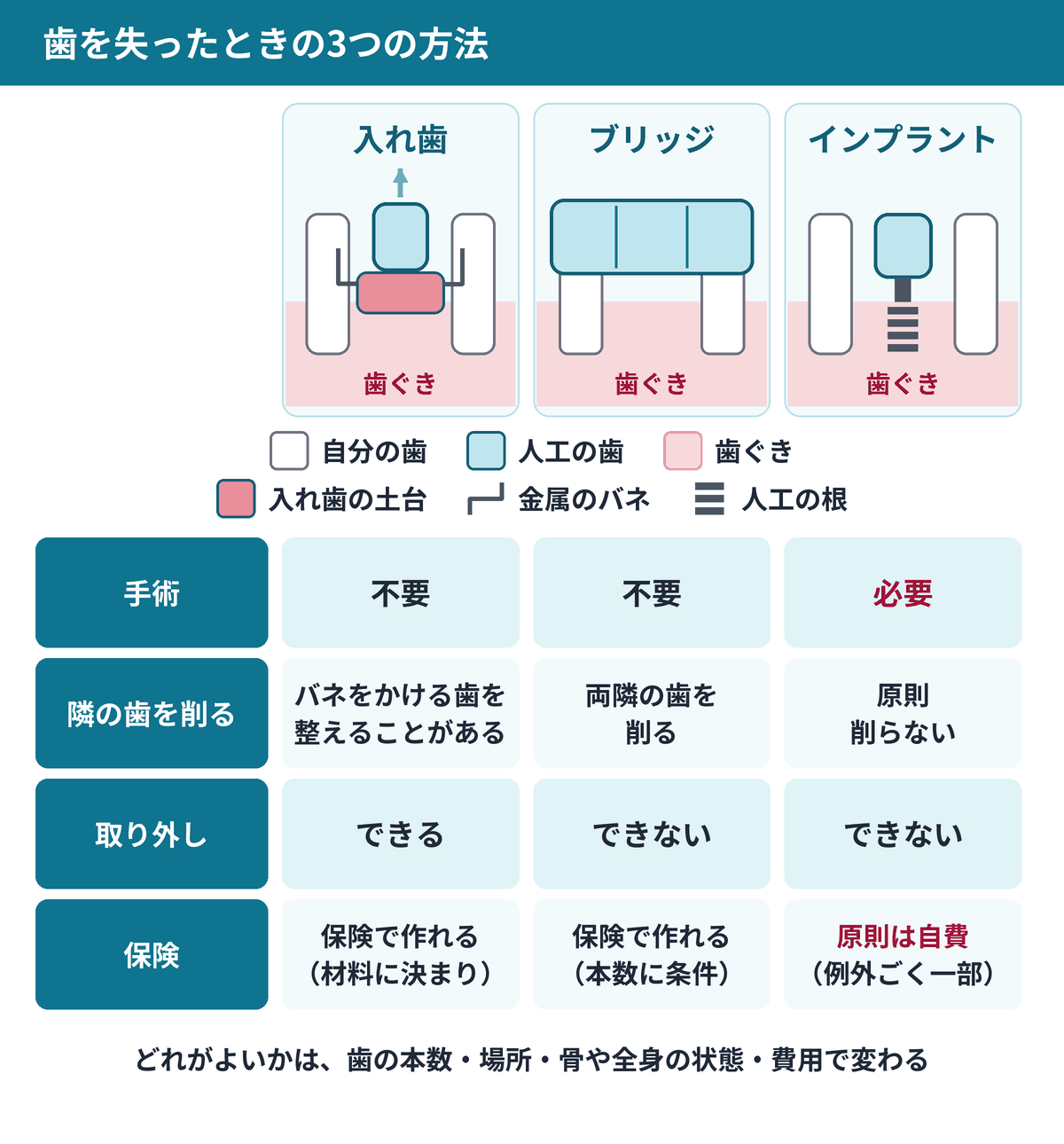 入れ歯・ブリッジ・インプラントの違いを、自分の歯・人工の歯・歯ぐきのラベル付きの記号で比較した図